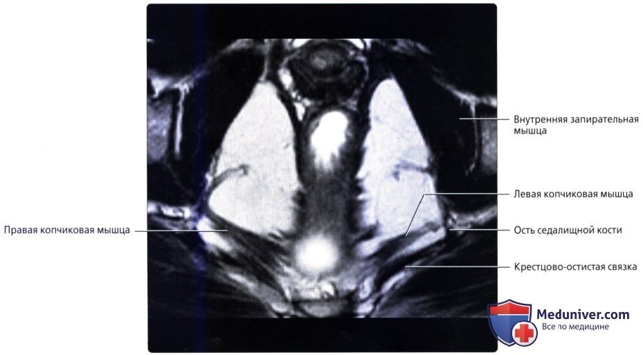 luchevaia_anatomia_tazovogo_dna_u_genchin-13-8692516