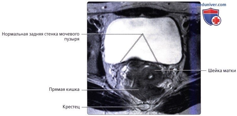 luchevaia_anatomia_tazovogo_dna_u_genchin-30-3749184